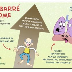 Syndrome barre guillain