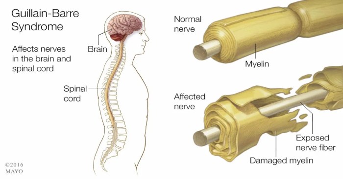 Guillain barre syndrome hesi case study