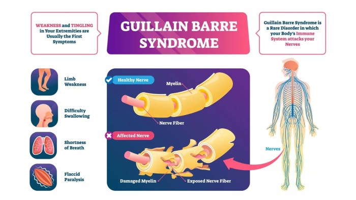 Guillain barre syndrome hesi case study